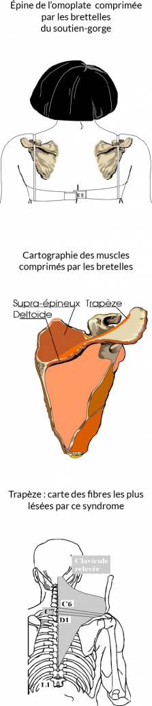 syndrome soutien-gorge osteopathie bernard rosa